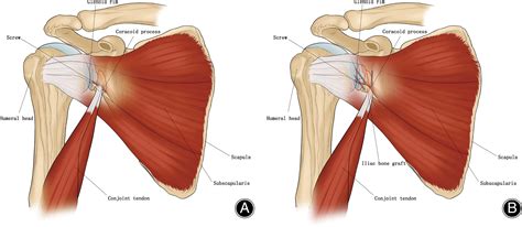 Muscles of the shoulder are a group of muscles surrounding the shoulder joint, which move and provide support to the said joint. Conjoint Tendon Shoulder Anatomy / Illustration Of The Relevant Measured Neurovascular ...