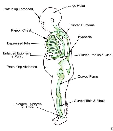 Hypophosphatemic Rickets Bone And Spine