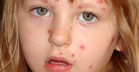 What Are The Symptoms Of Chickenpox