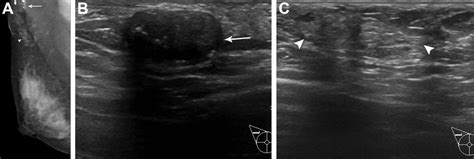 Sonographic Findings Of Accessory Breast Tissue In Axilla And Related