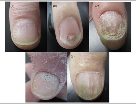 Psoriatic Nail Changes Are Associated With Clinical Outcomes In