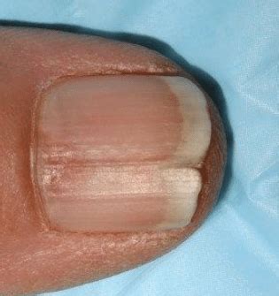 Having vertical (longitudinal) ridges on the fingernails refers to the presence of tiny raised lines or ridges that run up and down the length of the nail. Vertical Ridges on Nails Causes, Fingernails, Toenails ...
