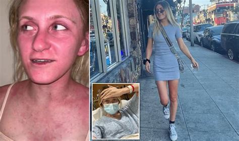 Woman Unknowingly Filmed Herself Going Into Anaphylactic Shock
