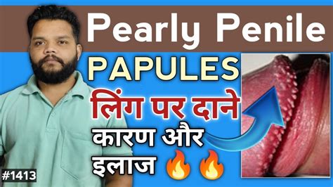 लिंग पर दाने क्यों होते हैं कैसे ठीक करें Pearly Penile Papules Cause