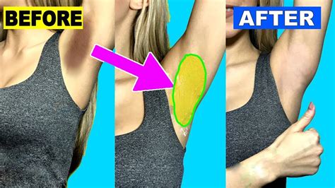 In Just 5 Minutes Remove Your Dark Underarms Using These Simple 4 Ingredients 100 Working