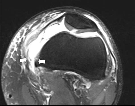 A Transverse T2 Weighted Fast Spin Echo Mri Of The Knee Obtained At