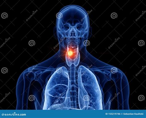 Cncer Da Laringe Ilustração Stock Ilustração De Tumor 155219746