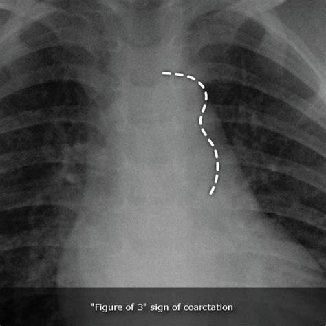 Figure 3 Sign Radiology Reference Article