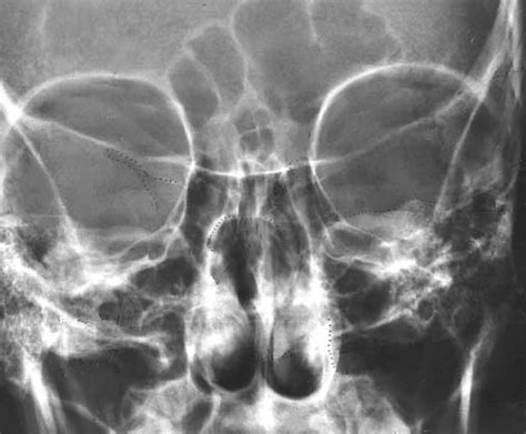 Skull Orbit Conventional Nu Fsom X Ray Program