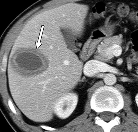 Amebic Liver Abscess In A 44 Year Old Woman Who Presented With Fever