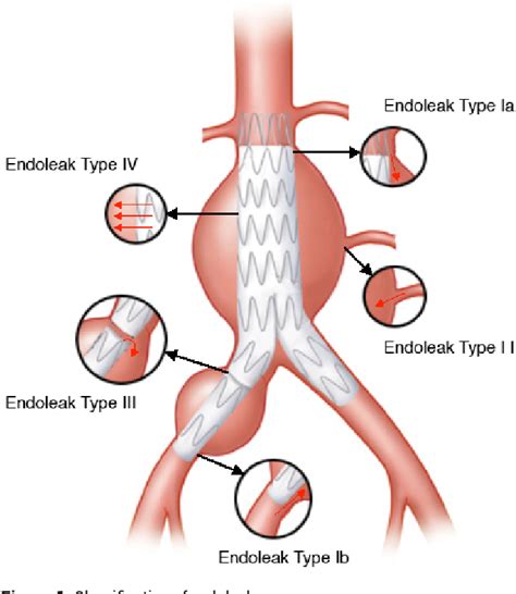 Endoleaks After Endovascular Abdominal Aortic Aneurysm Repair