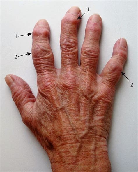 Healthline Pictures And Symptoms Of Arthritis In The Fingers