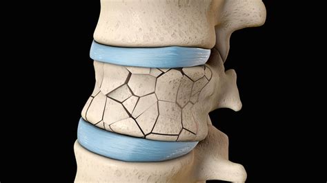 Why Kyphoplasty Is The Best Option For Spinal Compression Fractures