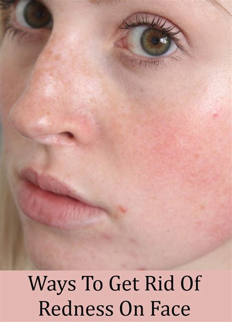 8 Simple Ways To Get Rid Of Redness On Face Search Home Remedy