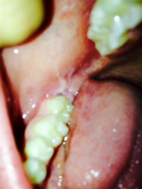 Extreme Gumjaw Pain Near Back Molars Thread Discussing Extreme Gum
