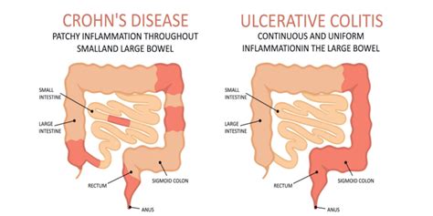 Inflammatory Bowel Disease Ibd Symptoms Causes