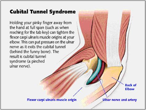 Cubital Tunnel Syndromewhat To Know