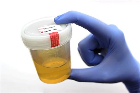 And the ability to perform semiquantitative. New urine test for malaria