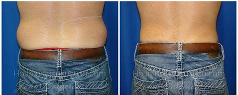 Liposuction Love Handles Men Before And After