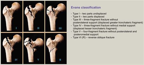 Overview Of Classification And Surgical Management Of Hip Fractures