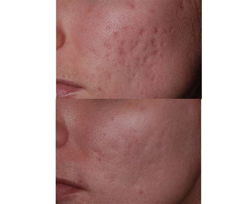 Acne And Acne Scarring Pima Dermatology