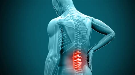 What Is A Herniated Disc Hgi Exchange