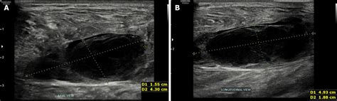Extracorporeal Shock Wave Therapy Treatment Of Painful Hematoma In The