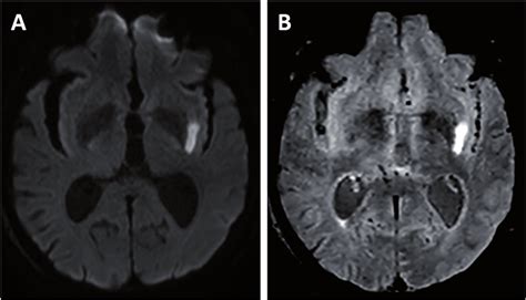 Acute Ischemic Stroke Of The Left External Capsule In A 88 Year Old Man