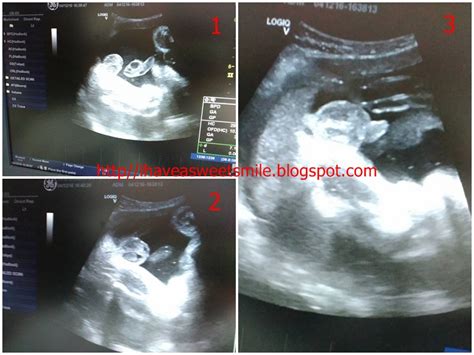 Untuk mendapat anak perempuan cecair. Scan (RME) kali kedua ketika mengandung anak ke 4