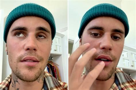 Justin Bieber’s Face Paralysis — What Is Ramsay Hunt Syndrome