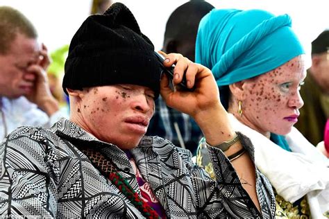 Albinos Worldwide Gather For International Albinism Awareness Day