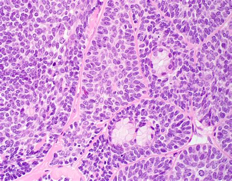 Pathology Outlines Basal Cell Adenocarcinoma