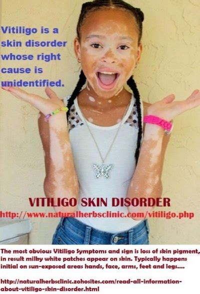 Read All Information About Vitiligo Skin Condition