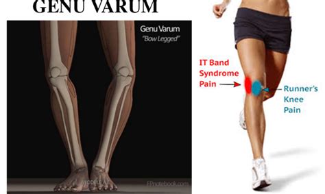 Diagnosing Lateral Thigh Pain It Band Syndrome Hip Bursitis And