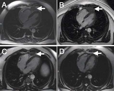 Figure 1 From Primary Pericardial Malignant Mesothelioma And Response