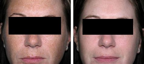 Ipl Therapy Before And After Kingsway Dermatology