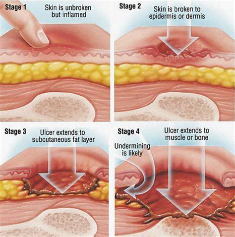 Bed Sores Decubitus Ulcers Stages Causes Symptoms Treatment Dr Sexiz Pix