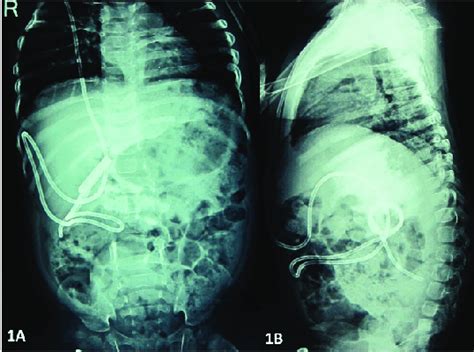 Ab Plain X Ray Abdomen Ap And Lateral Views Showing The Coiled Vp