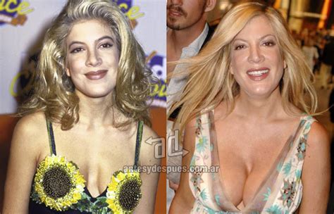 Tori Spelling Before And After Surgery Xpicse Com