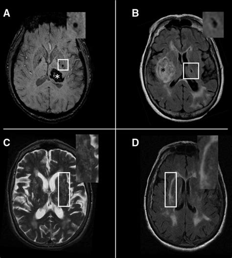 Clinical Relevance Of Cerebral Small Vessel Diseases Stroke