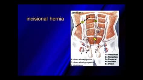 Ultrasound Of Hernias Ultrasound Book Cover Umbilical Hernia Sexiz Pix