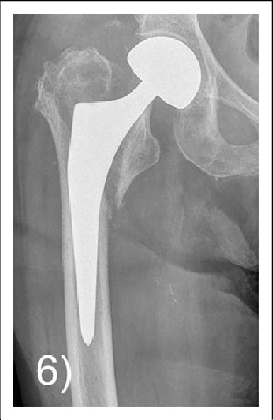 Periprosthetic Fracture Vancouver Type B2 Detected During
