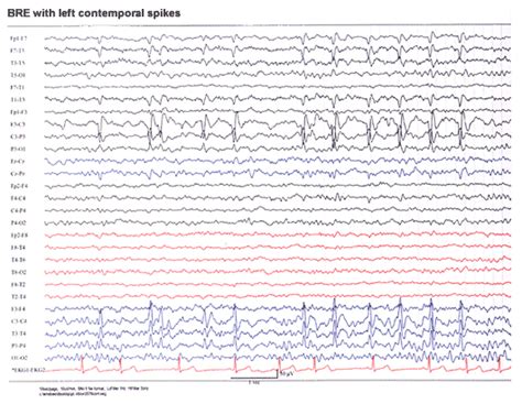 Benign Rolandic Epilepsy Normal Background With Centrotemporal Spikes