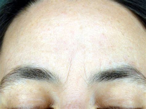 before and afterbotox — cpw vein and aesthetic center