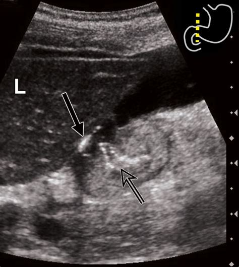 Perforated Pyloroduodenal Peptic Ulcer And Sonography Ajr