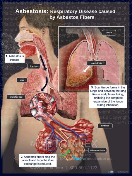Asbestosis Respiratory Disease Caused By Asbestos Fibers
