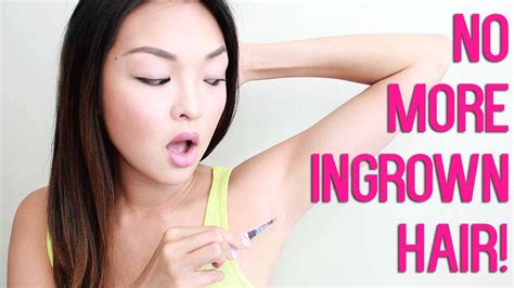 Let's read 2 methods used to extract hair bulb from an ingrown hair cyst the most effectively. How To Get Rid Of Ingrown Hair Quickly And Safely ...