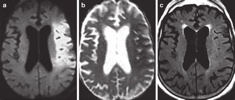 5 Superiority Of Dwi Imaging For Detection Of Early Ischemic Change