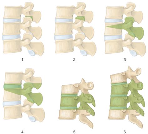 T2 Pedicle Subtraction Osteotomy For Rigid Cervicothoracic Deformity