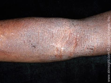 Atopic Dermatitis National Eczema Association